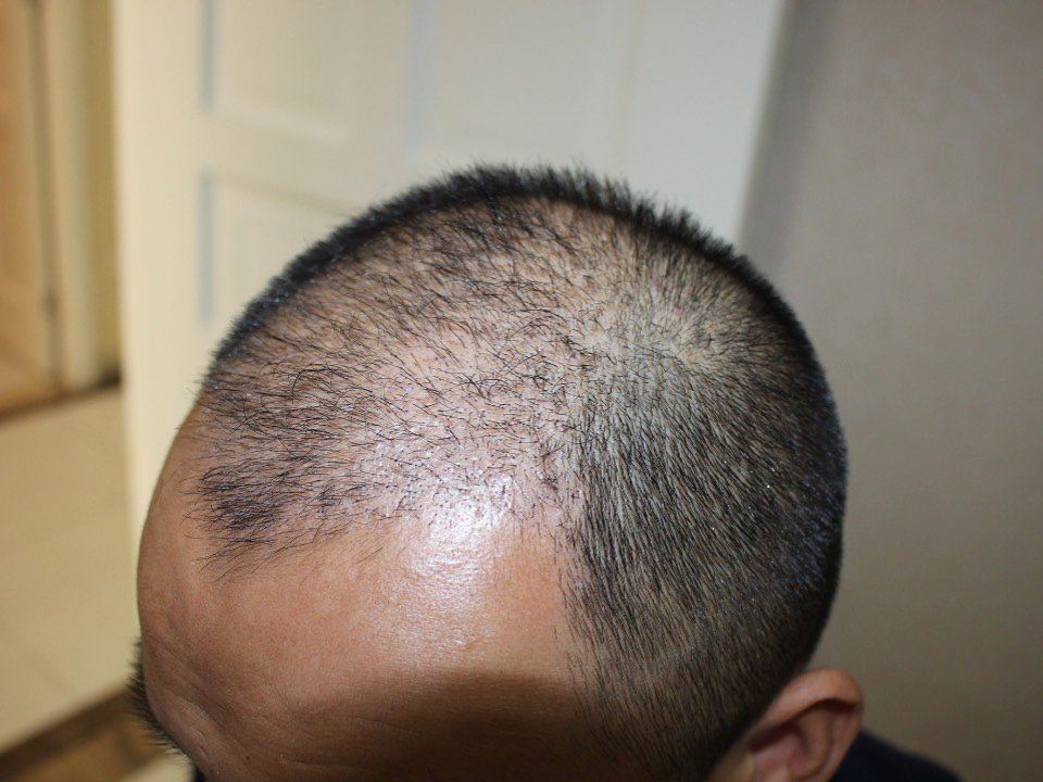 【科发源植发】种植区的头皮和周边的头皮颜色不太一样_圈子-新氧美容