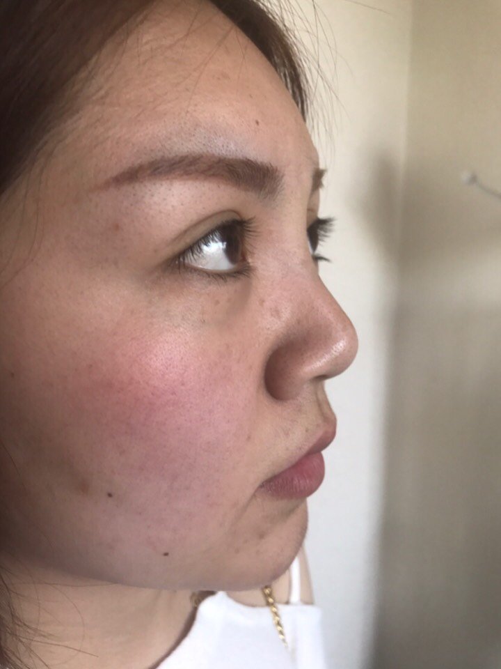 我鼻梁也不低,就是鼻头向下不好看,想做垫鼻尖手术,_圈子-新氧美容