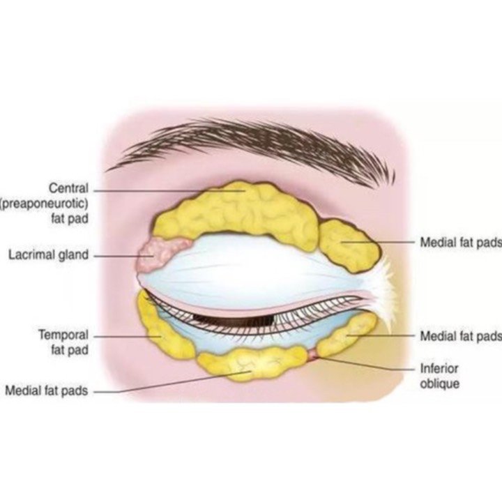 肿泡眼不仅仅是眶隔脂肪臃肿造成,roof层脂肪臃肿也会产生肿泡眼