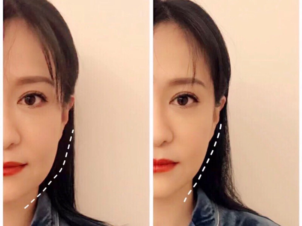 亚洲邪术日式小颜整骨矫正体验