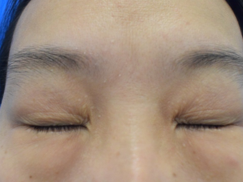 我的上眼睑下垂很严重,导致我的眼皮看起来很多层,这_圈子-新氧美容