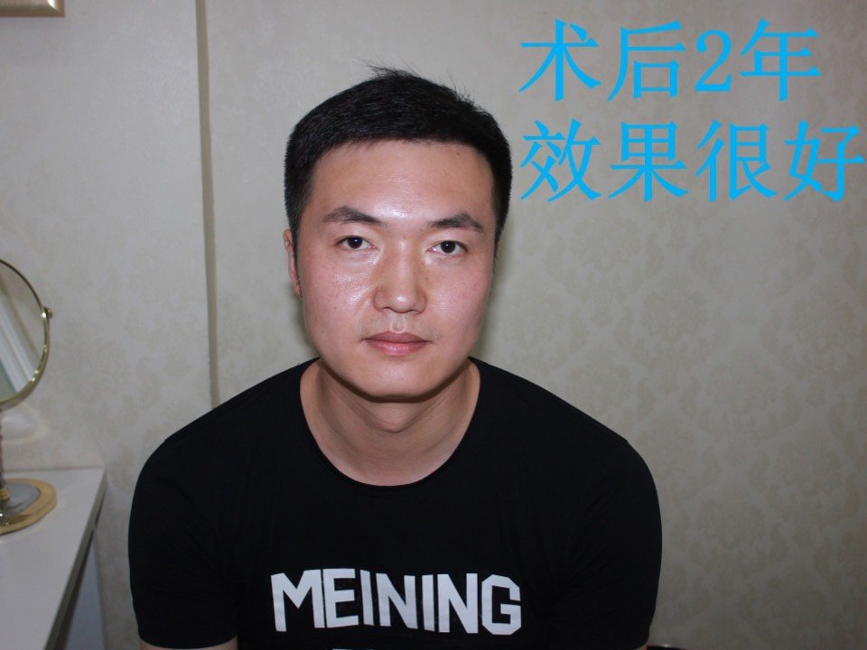 大麦植发大概多久(大麦植发多久后会恢复原状)