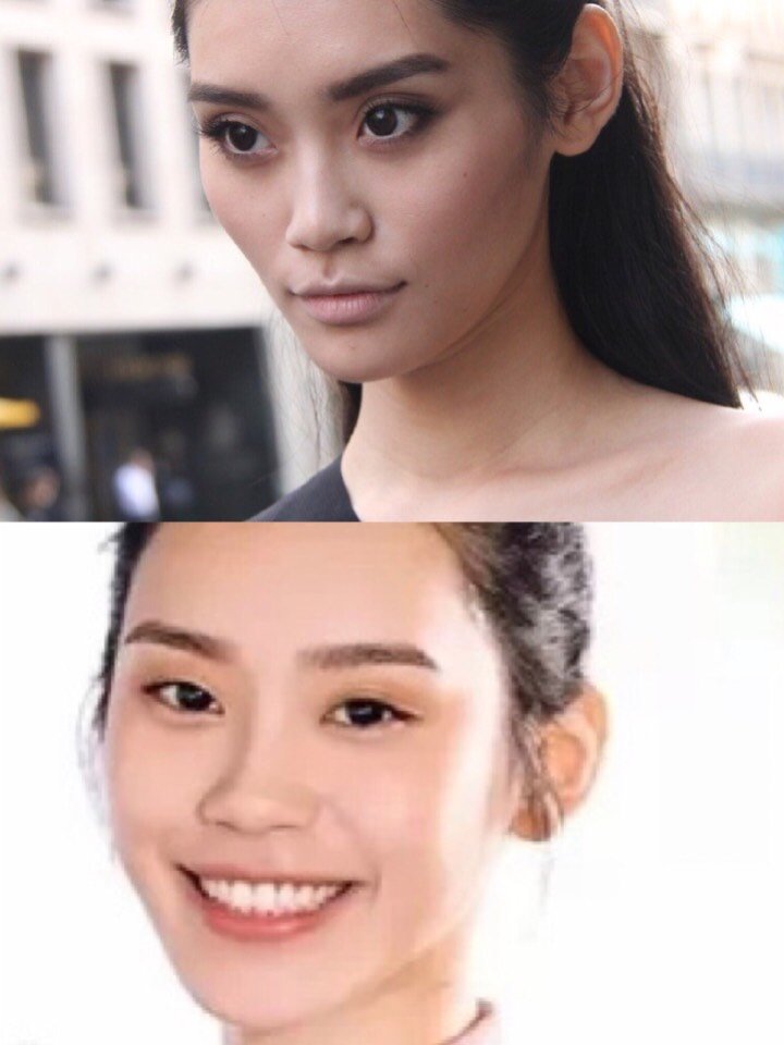 奚梦瑶颧骨内推了吗奚梦瑶 填充奚梦瑶脸部填充对比奚梦瑶对比照片