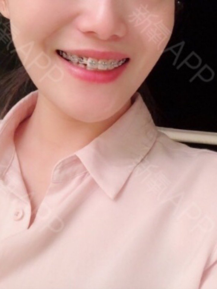 金属托槽矫正金属矫正牙齿矫正正畸牙齿嘴凸龅牙牙缝大牙齿前凸拥挤