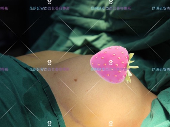 患者年龄:31岁职业:宝妈术前情况:【胸部干扁下垂_圈子-新氧美容整形