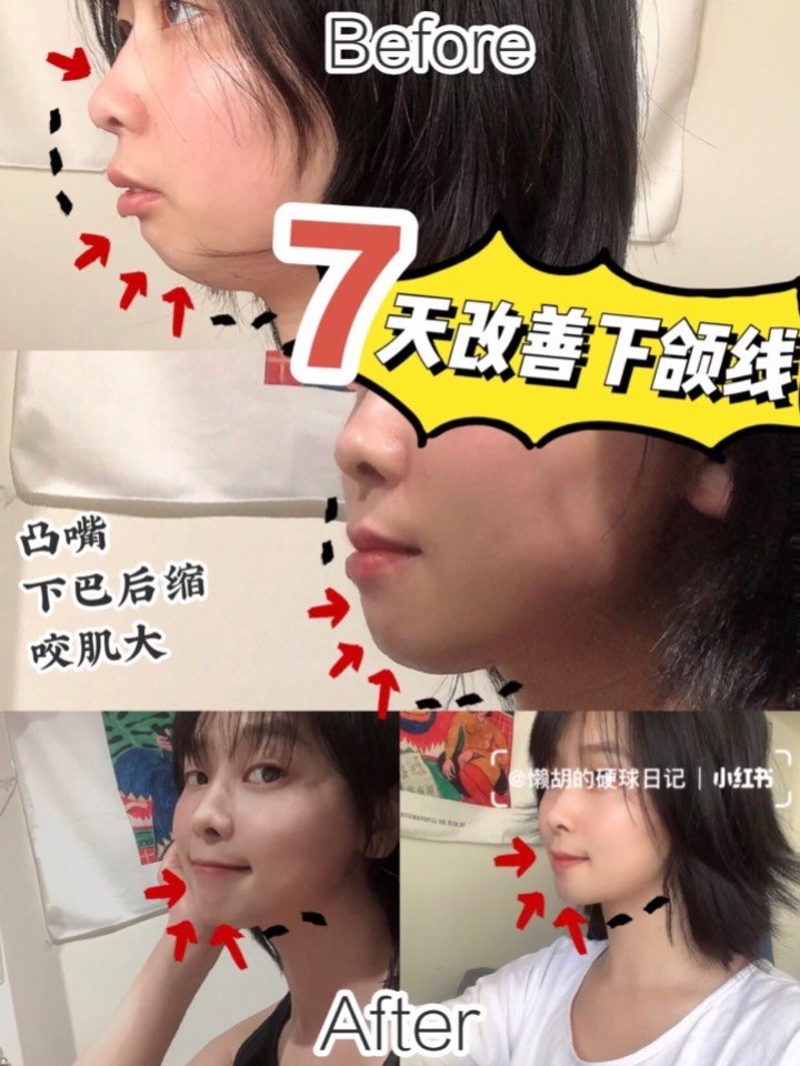 71566天挑战下颌线97告别凸嘴7515下巴后缩(二) 作_圈子