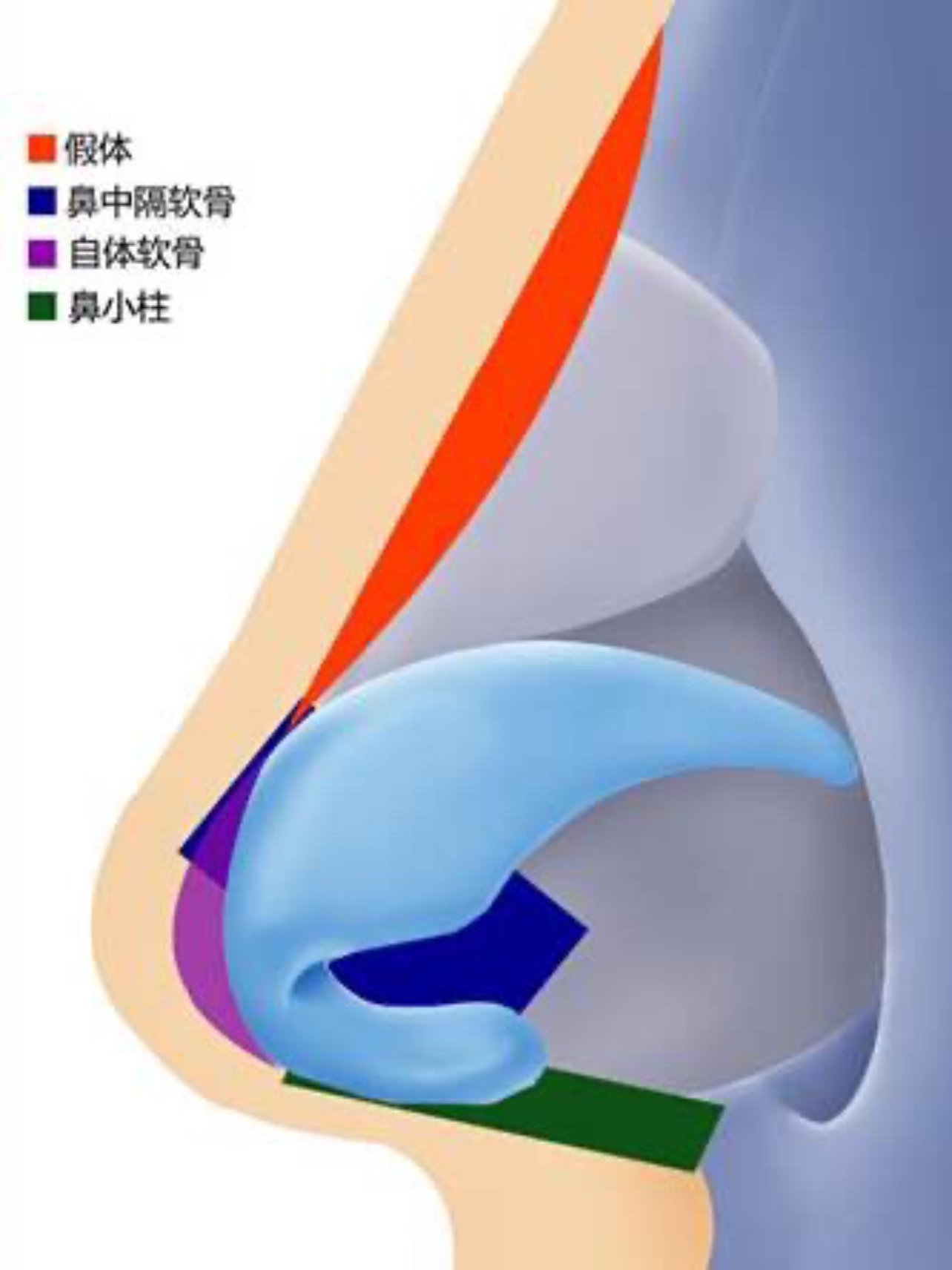 60隆鼻一年半后我的假体居然下滑了60
