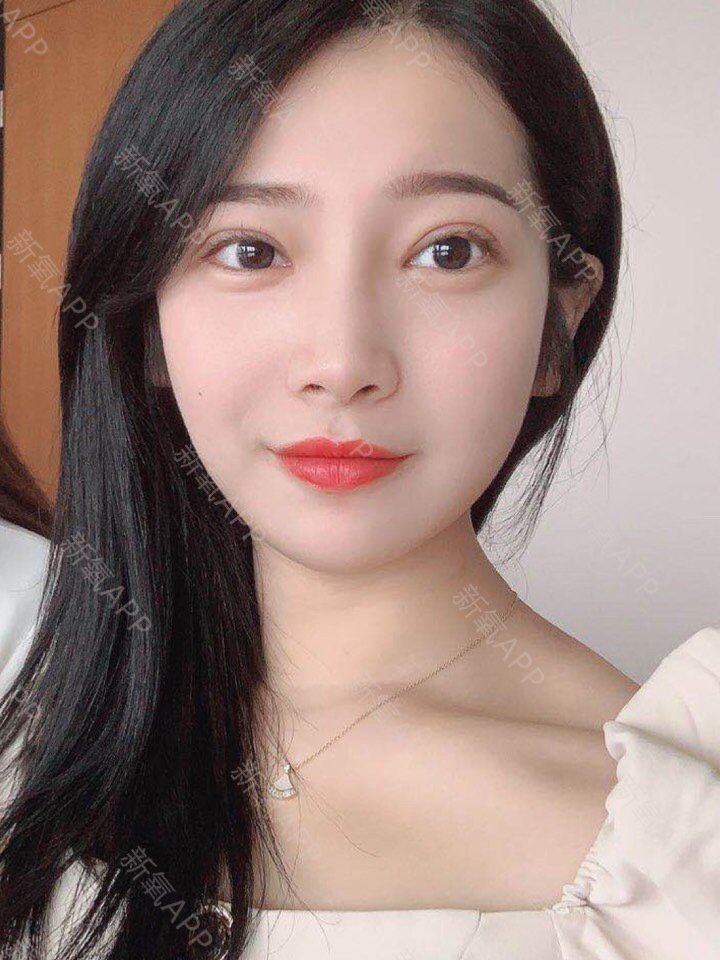 【双眼皮术后20天】