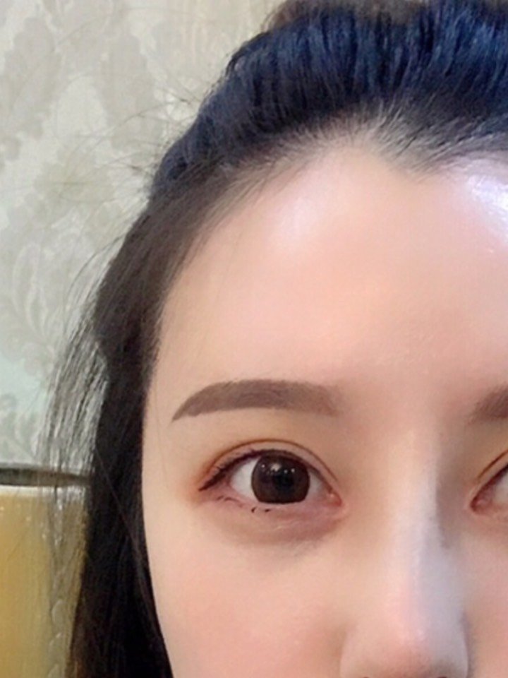 双眼皮第二次全切77内眼角大开