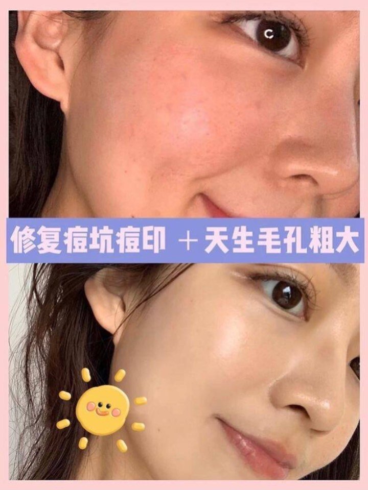 如何收缩毛孔的医美干货"毛孔粗大"的你选对了么