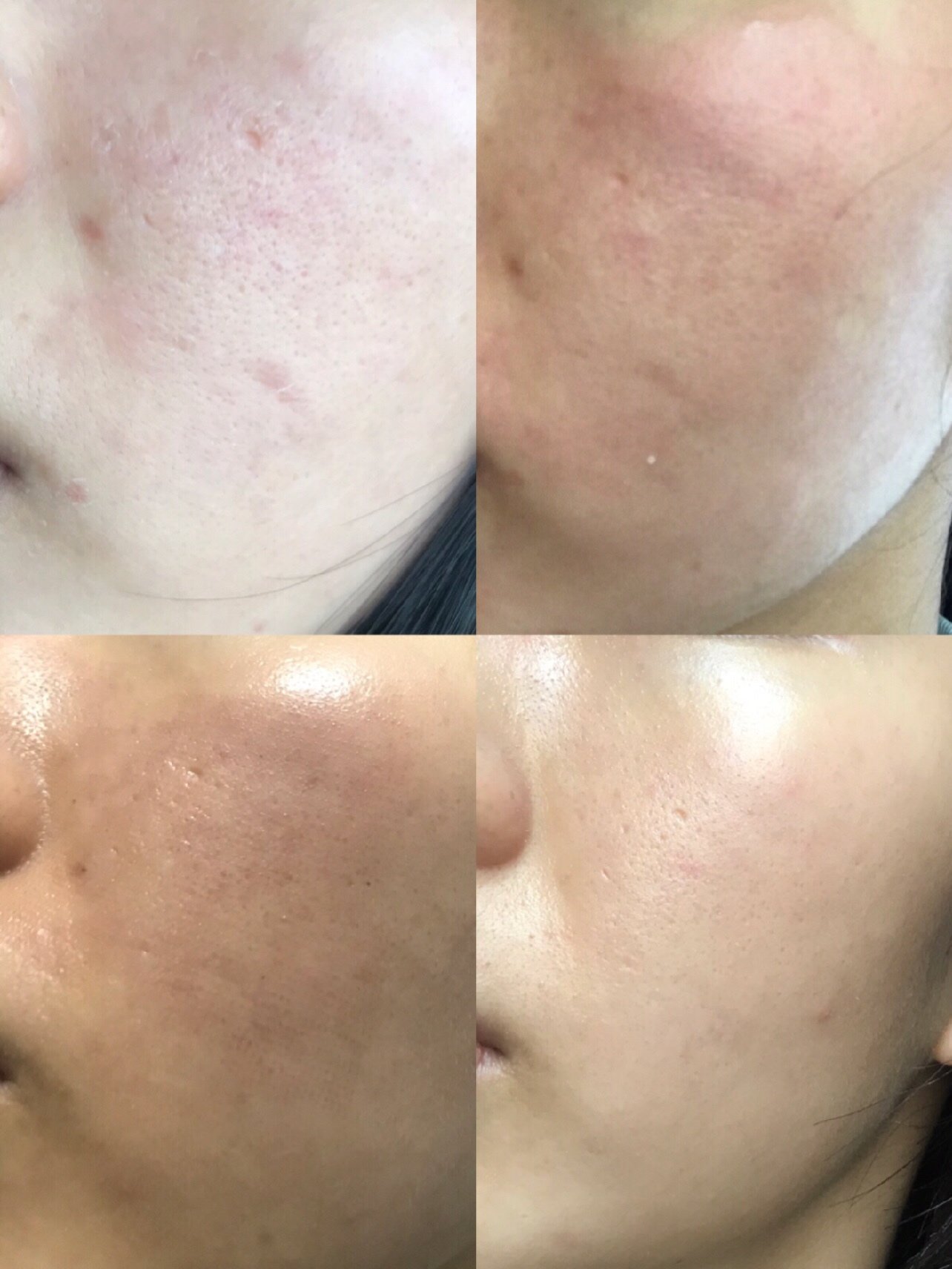全脸非剥脱77局部剥脱点阵激光术后效果