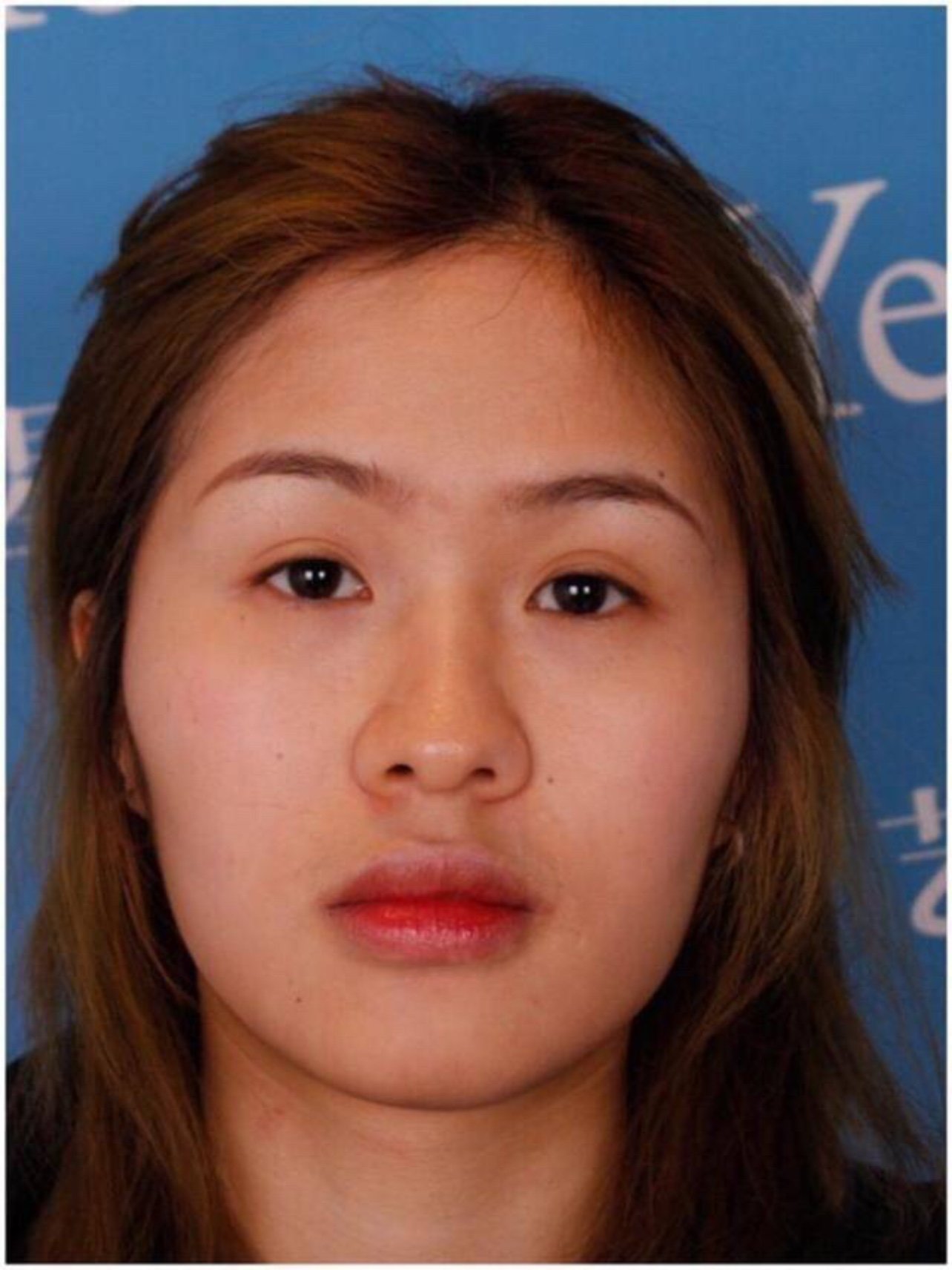 关于鼻部多项/隆鼻,请收起你们的想象力.