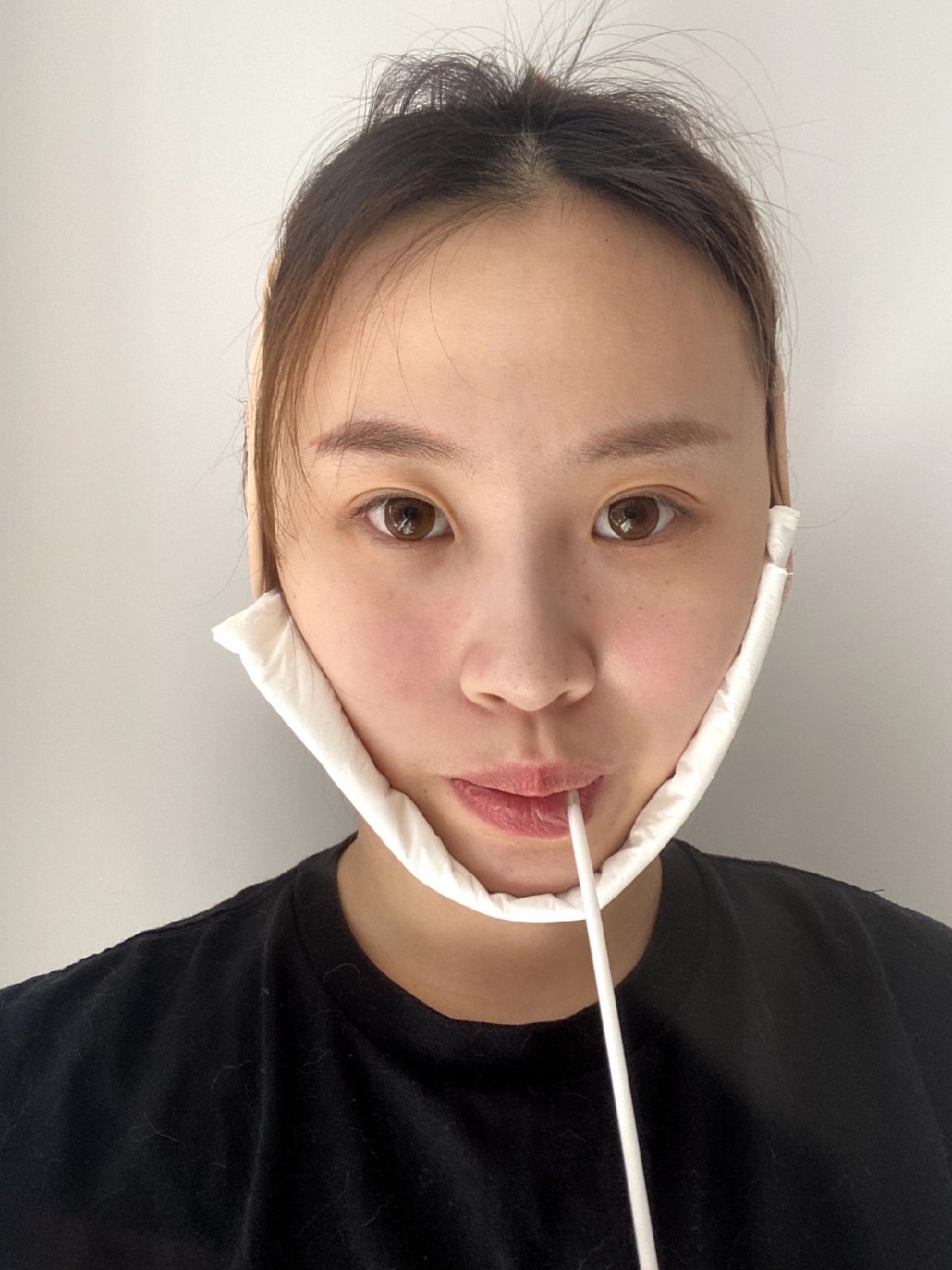 97个人感受:下颌角肥大的弊端说实话不用我说相信大家_圈子-新氧