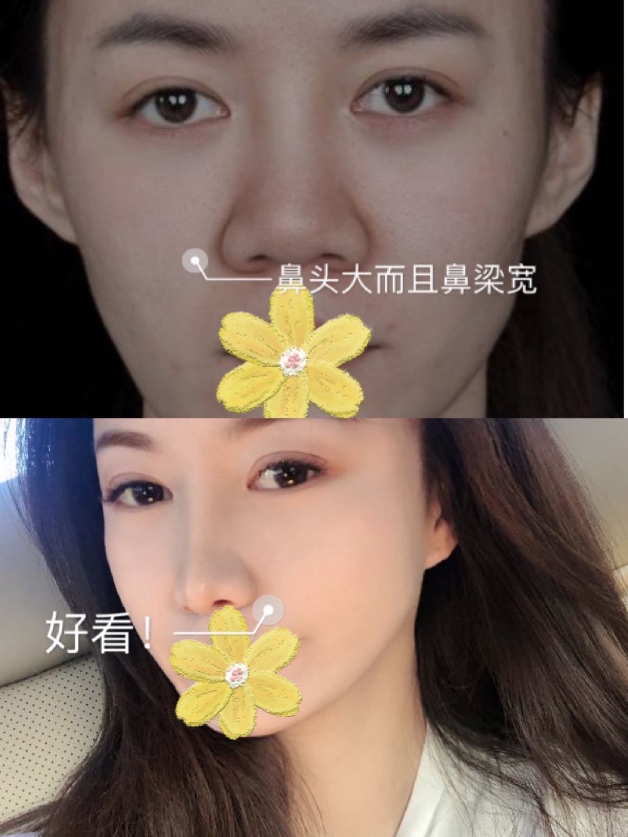 耳软骨隆鼻需要拆线吗_耳软骨隆鼻子要住院吗_耳软骨综合隆鼻需要多少钱