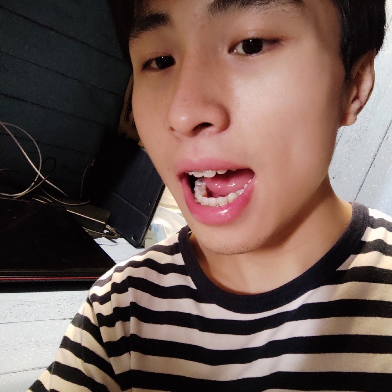 昨儿又去当代检查牙齿了,因为托槽掉了,还给我紧了紧钢丝,牙齿就又