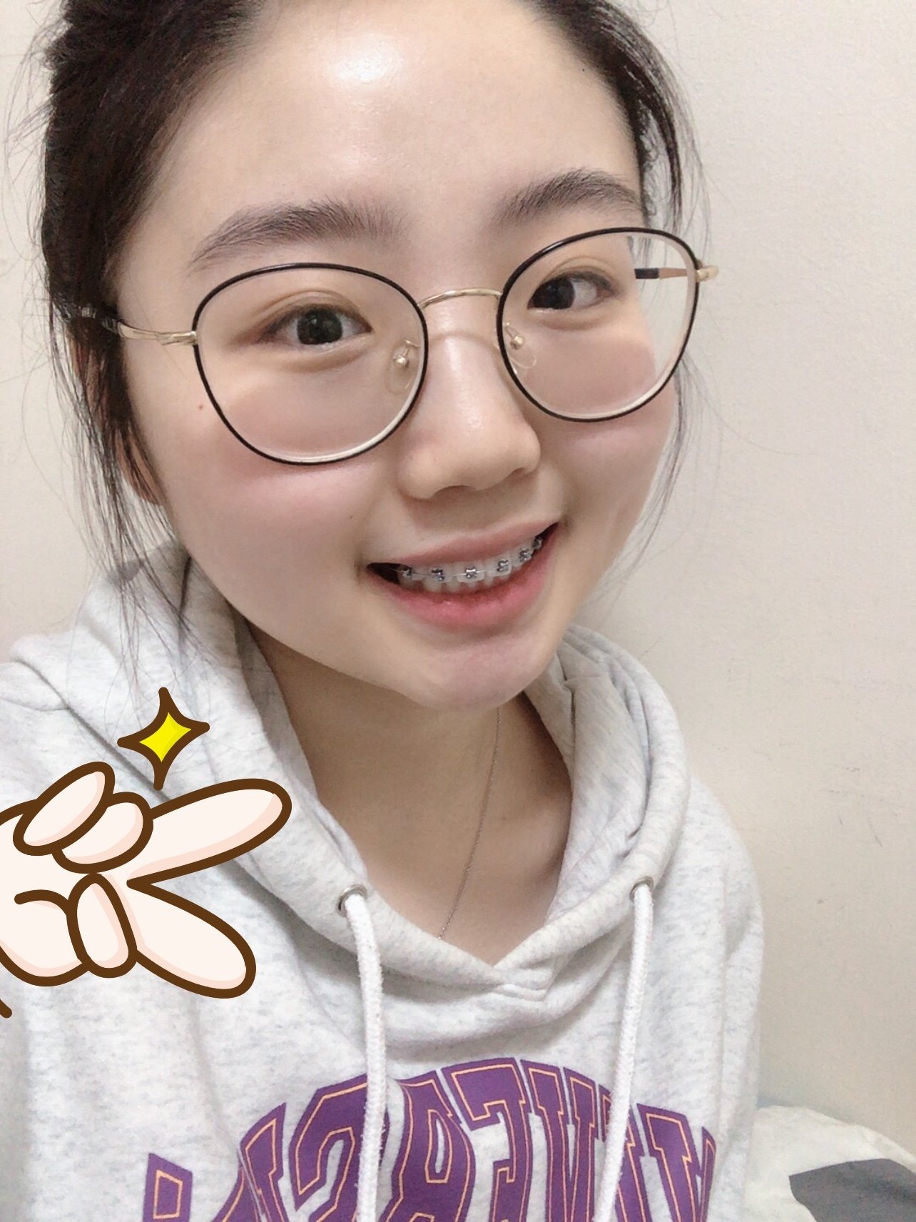 小姐姐的牙套日记~~牙套218天,上牙收进去了,下巴也变长了,好开熏