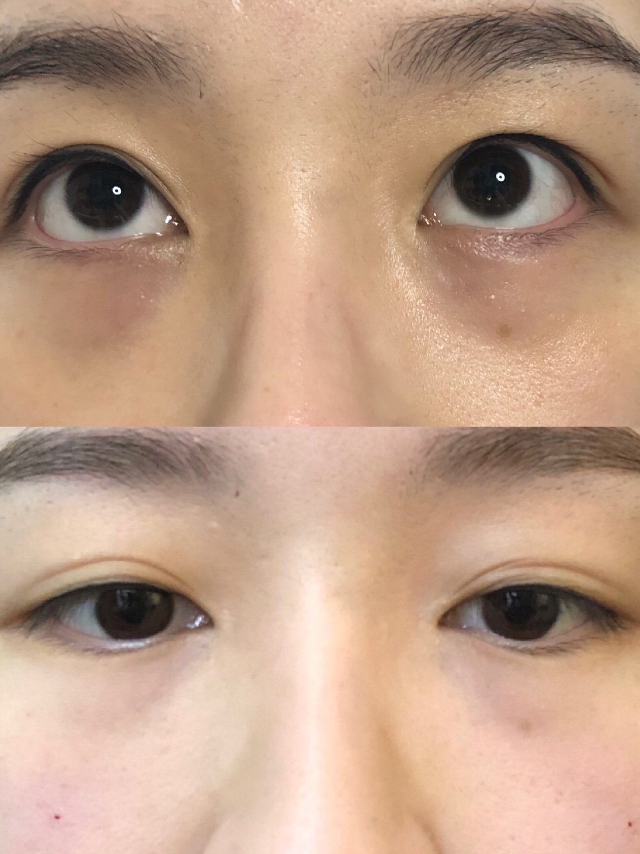 没眼袋简直帅成吴彦祖,可想而知眼袋有多么多么的显老了