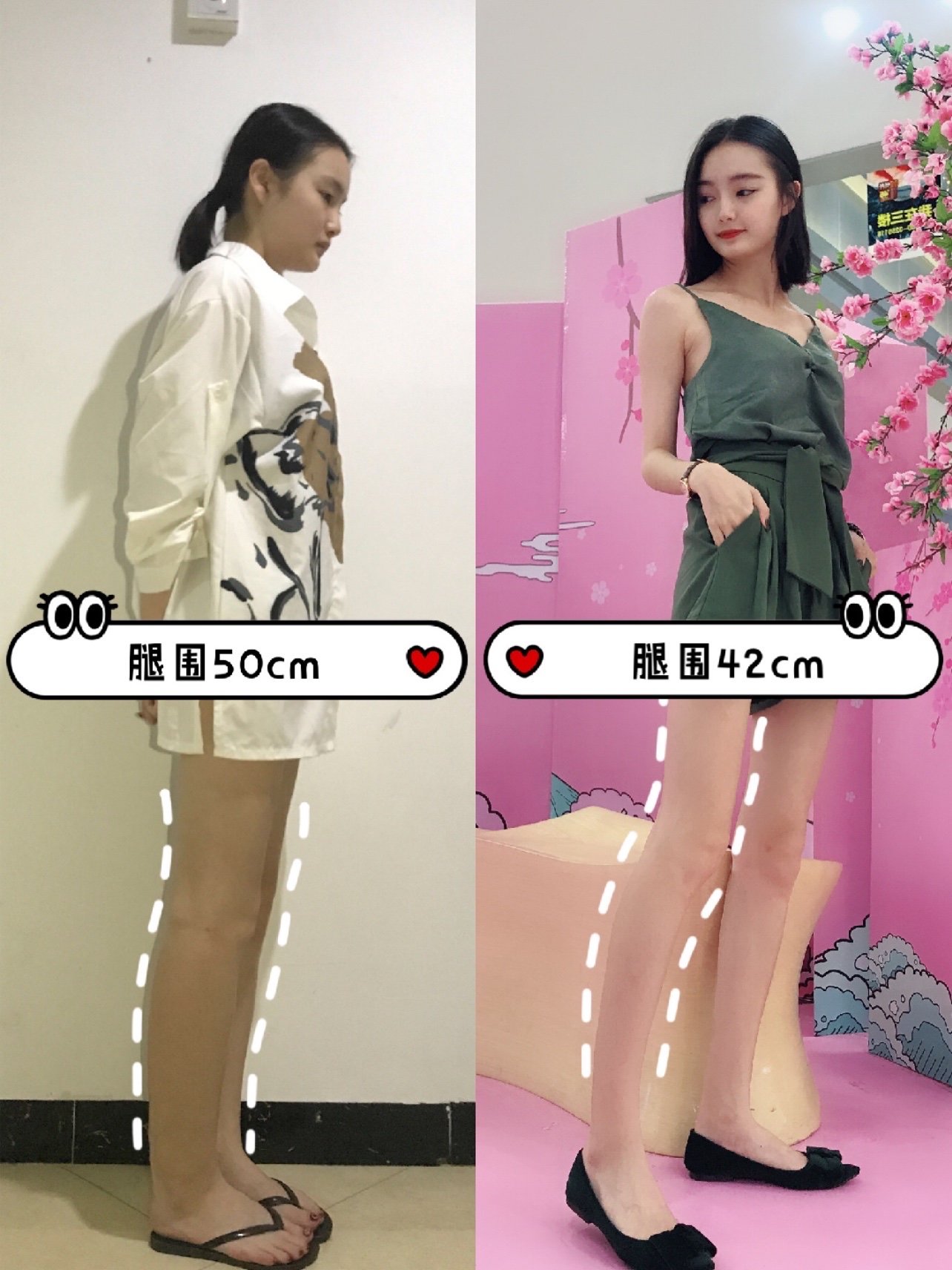 个人感受: 现在大腿环吸已经2个月左右,腿围小了一圈,从之前的50cm到