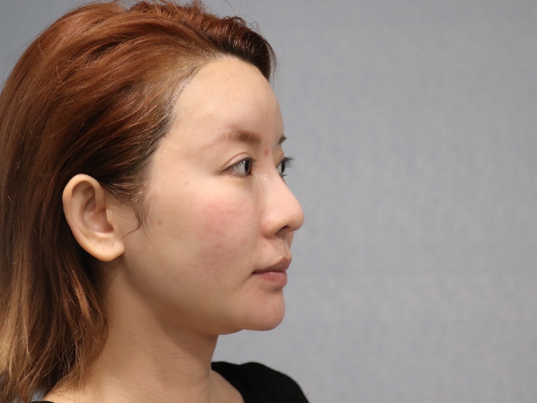 年纪大了 就感觉自己脸肉肉的 松77垮了 下颌缘模糊_圈子-新氧美容