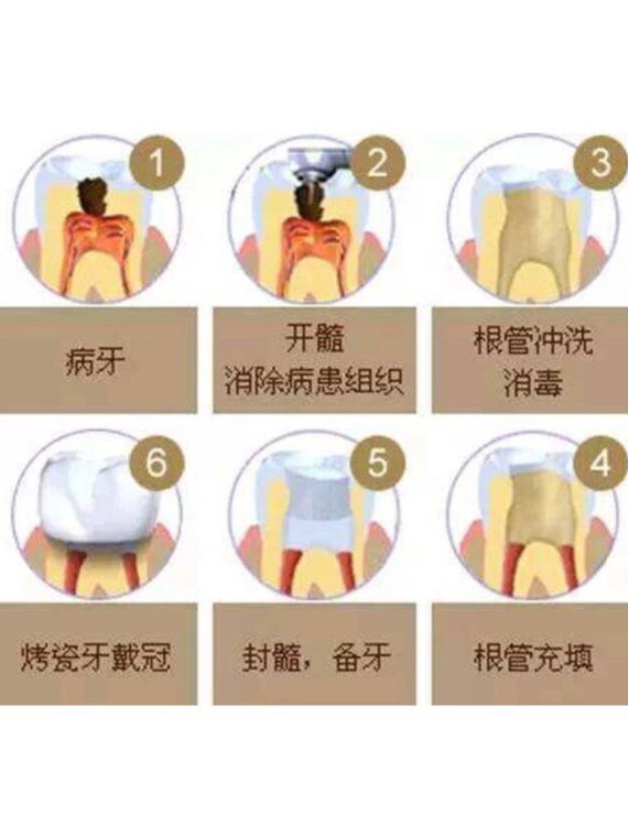 蛀牙过多不能补,只能拔掉