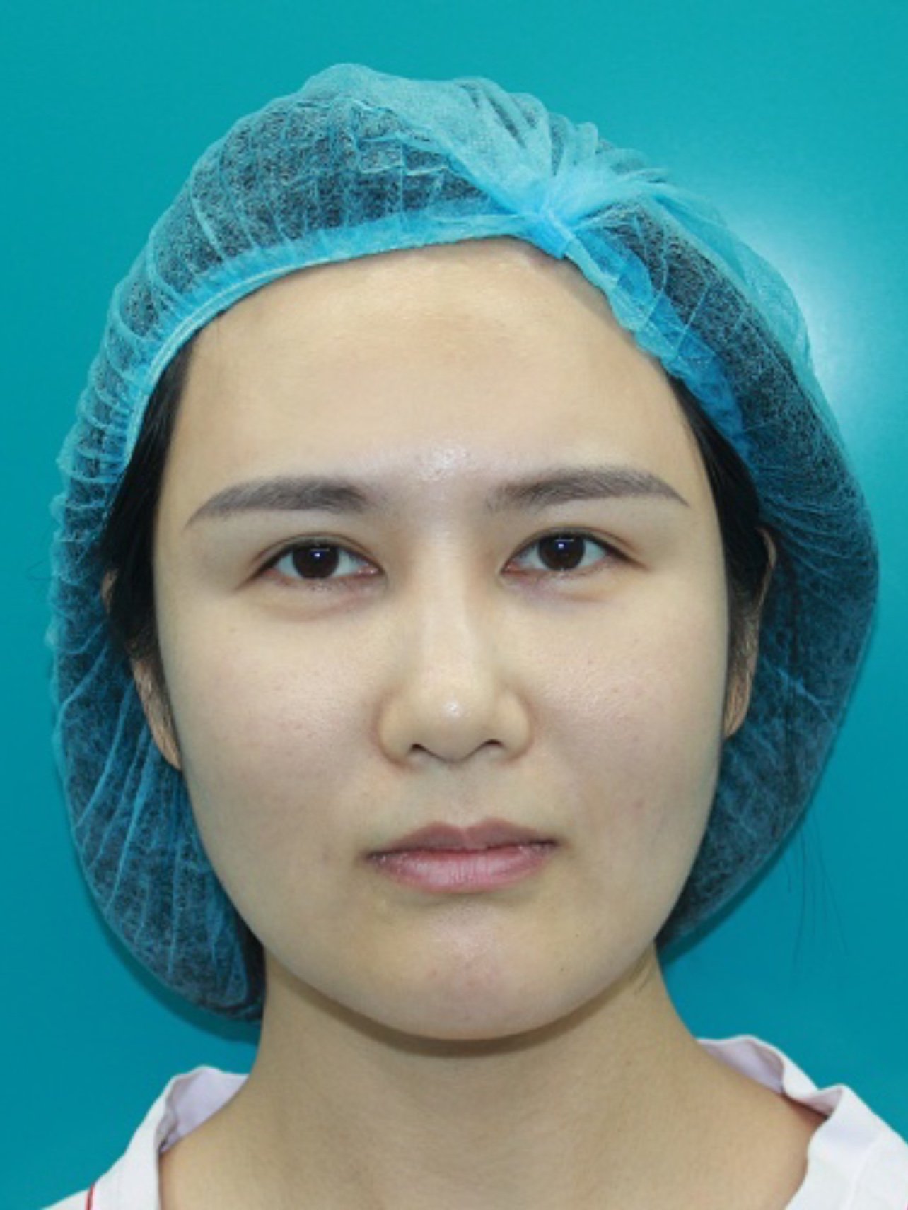 我是典型的中国人的鼻子,矮,段,平,从侧面看就看不_圈子-新氧美容整形