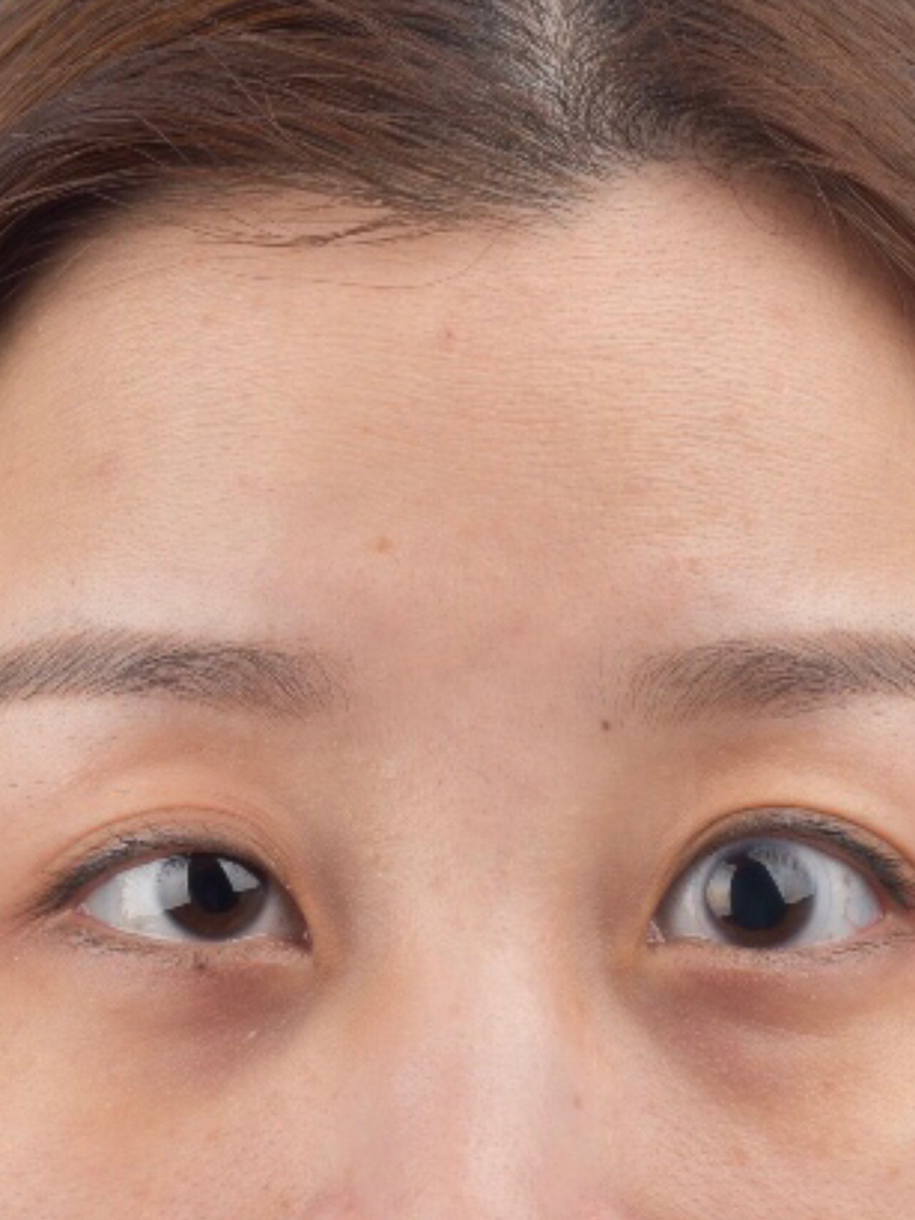 我是做的双眼皮成型,单眼提肌,单眼退缩矫正.