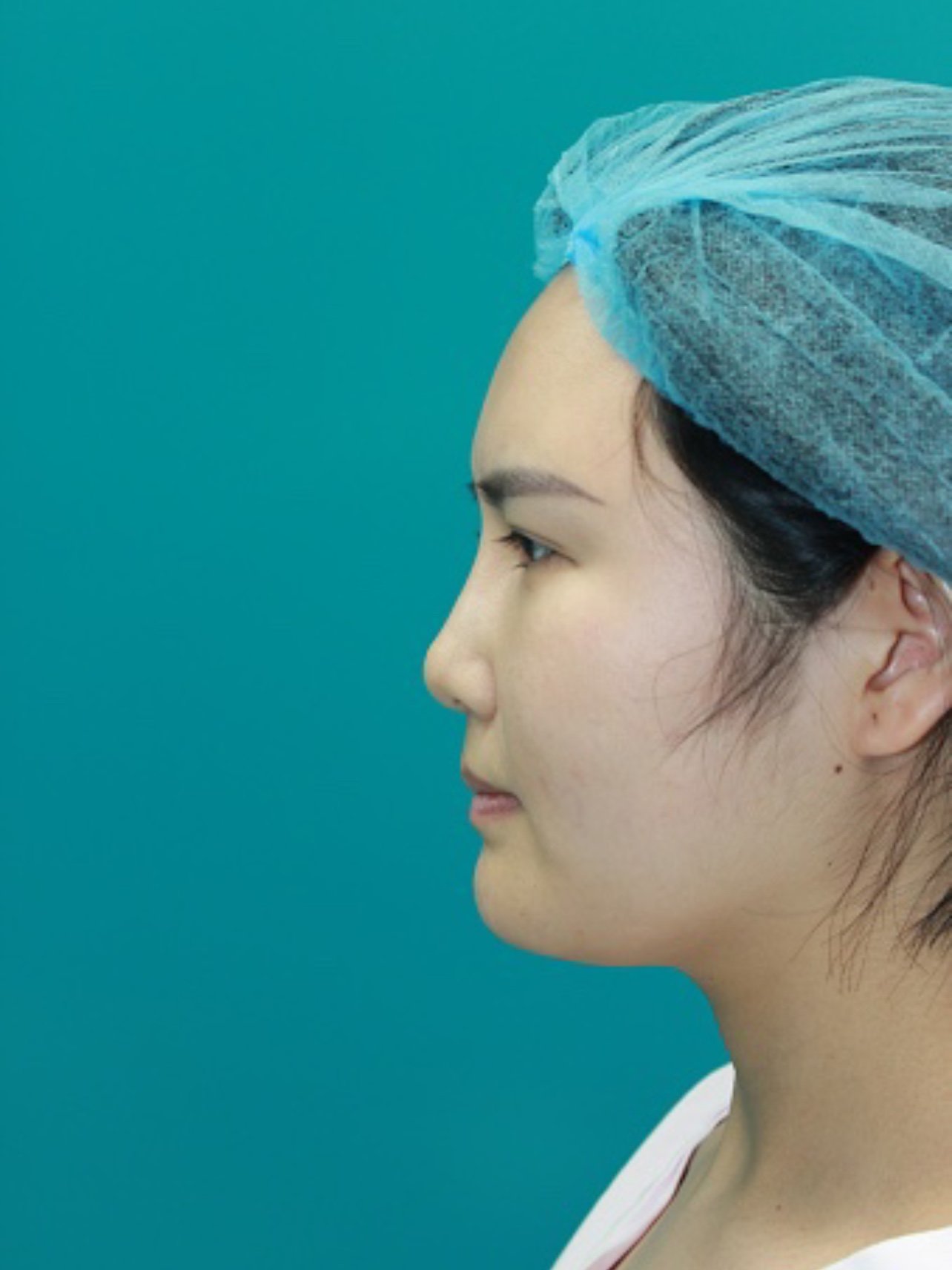 我是典型的中国人的鼻子,矮,段,平,从侧面看就看不_圈子-新氧美容整形