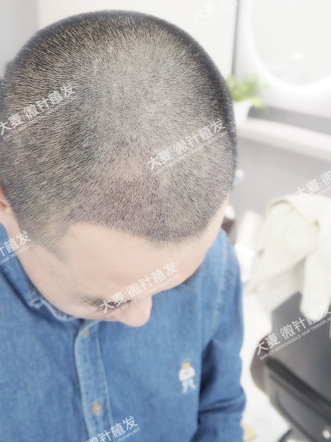 两旁取发植发(植发可以用两边的发源吗)