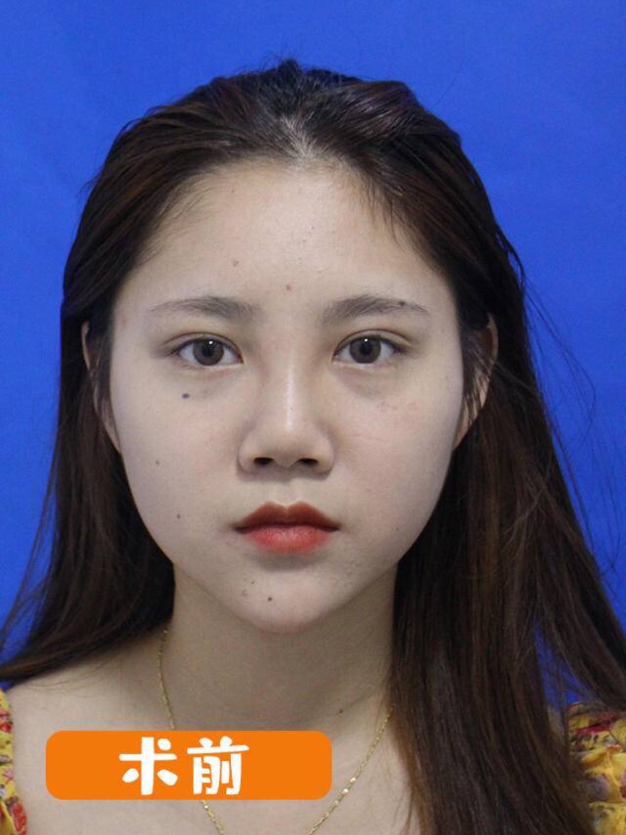 【案例分享从村土平面脸变混血高级脸!做了鼻子就有这么神奇】