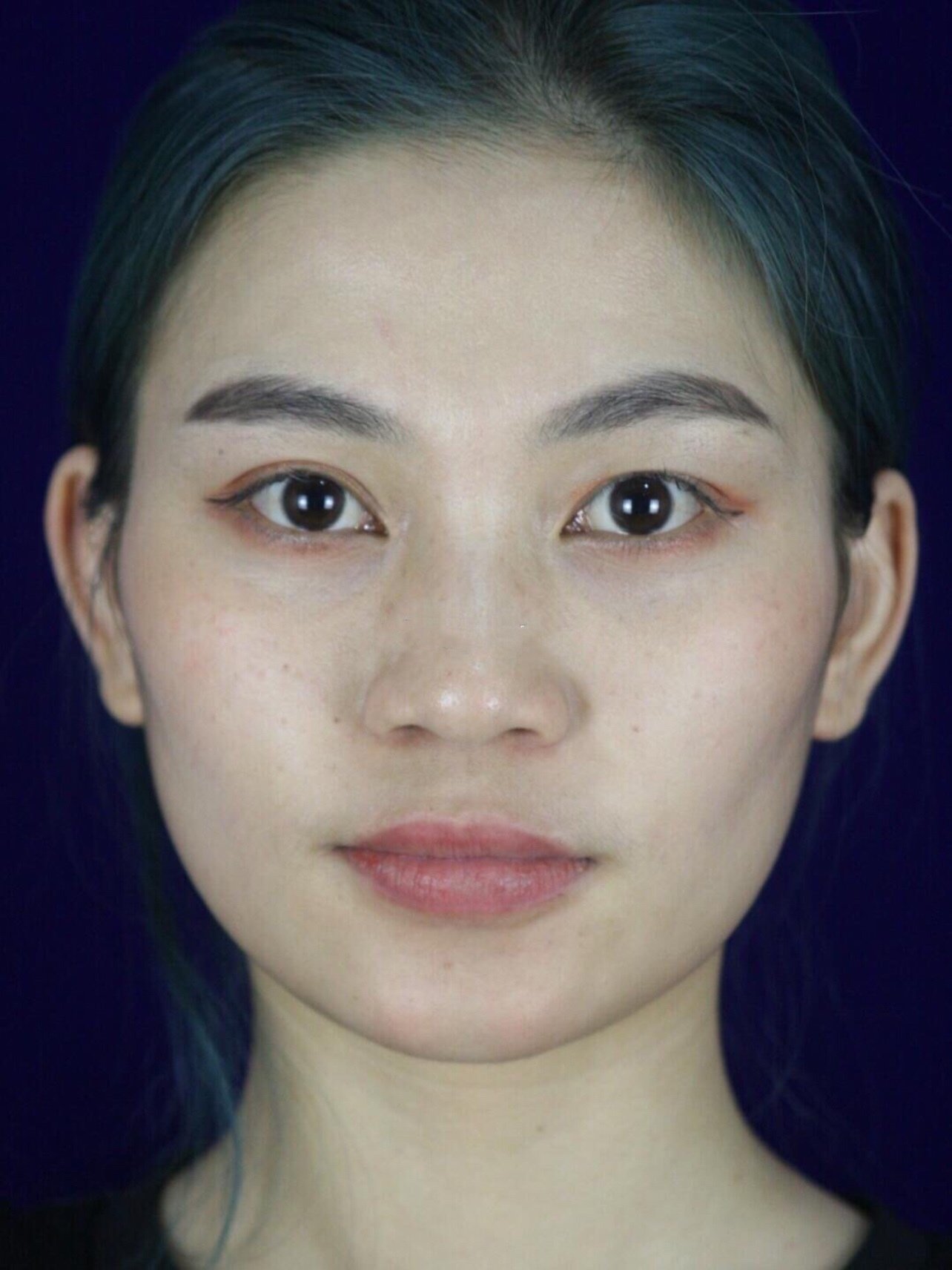 鼻子挺了整个五官都紧凑了感觉脸都小了,图二是没做鼻_圈子-新氧美容