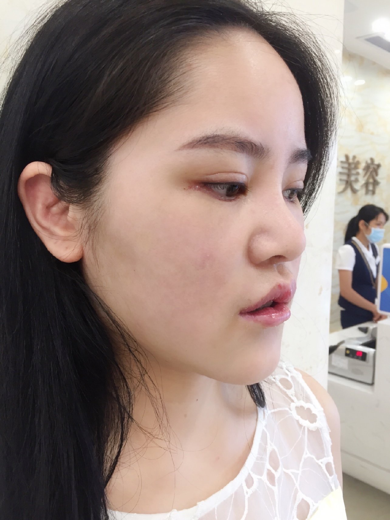 前几天去这家医美做了嘴巴,眼睛和脸部线雕,现在已经_圈子-新氧美容