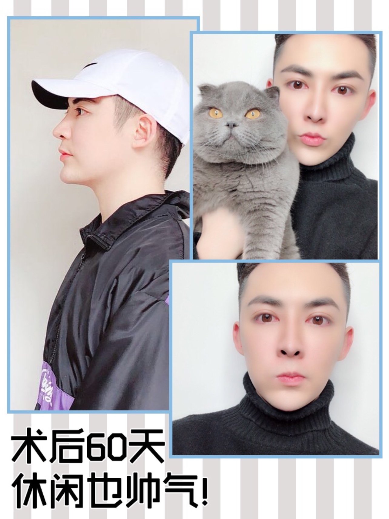 谁说男生不能鼻整形 网红男主播鼻整形记录新鲜出炉 圈子 新氧美容整形