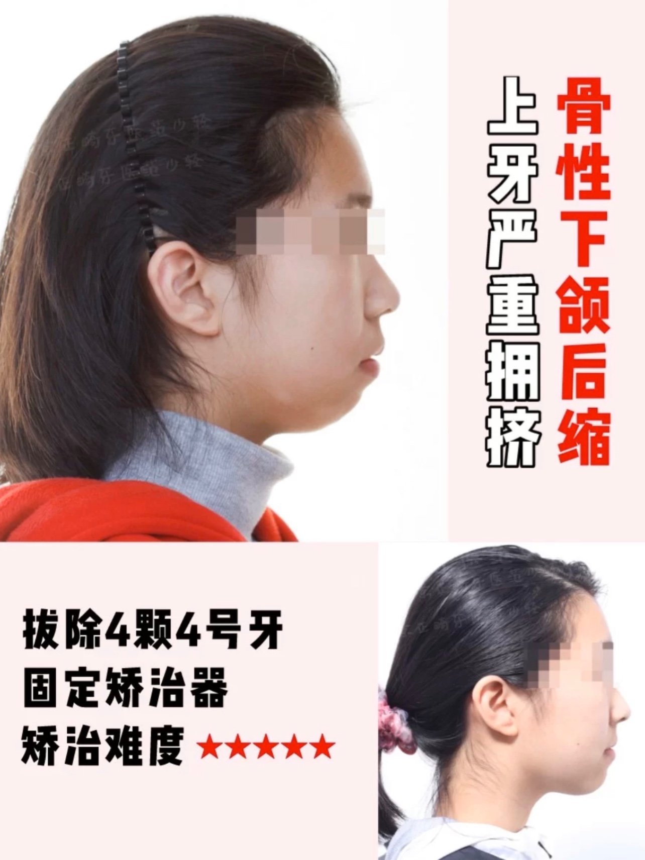 牙齿问题骨性下颌后缩上颌牙齿严重拥挤