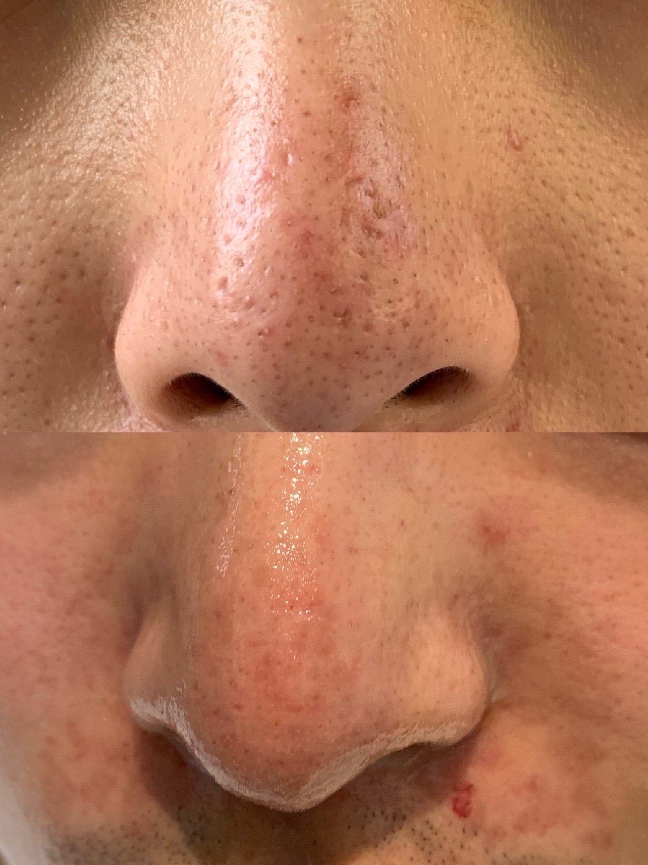 从小就爱挤黑头久而久之就变成了酒糟鼻也看过很多医院都治标不治本在