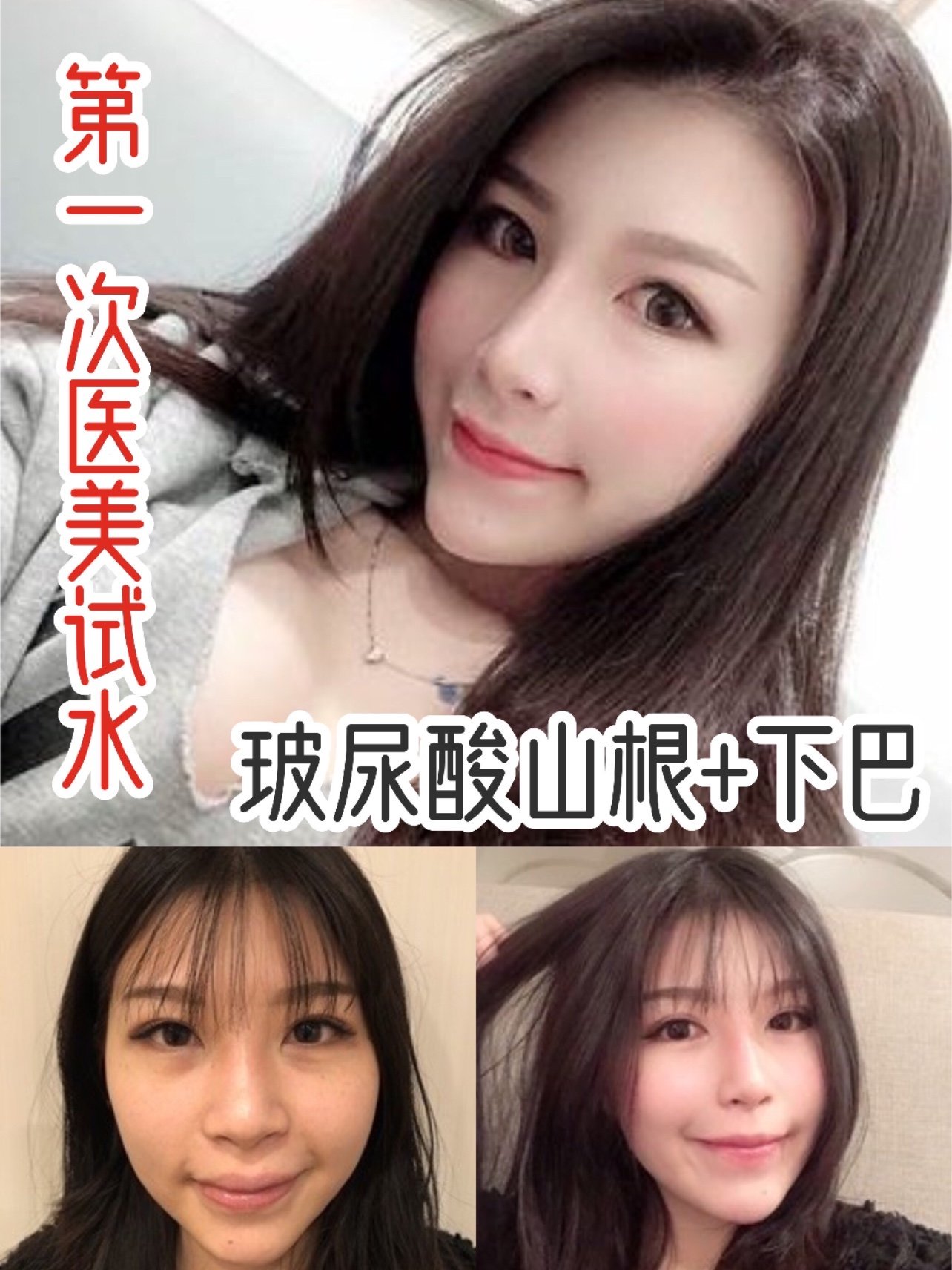 第一次医美试水玻尿酸山根下巴神仙颜值