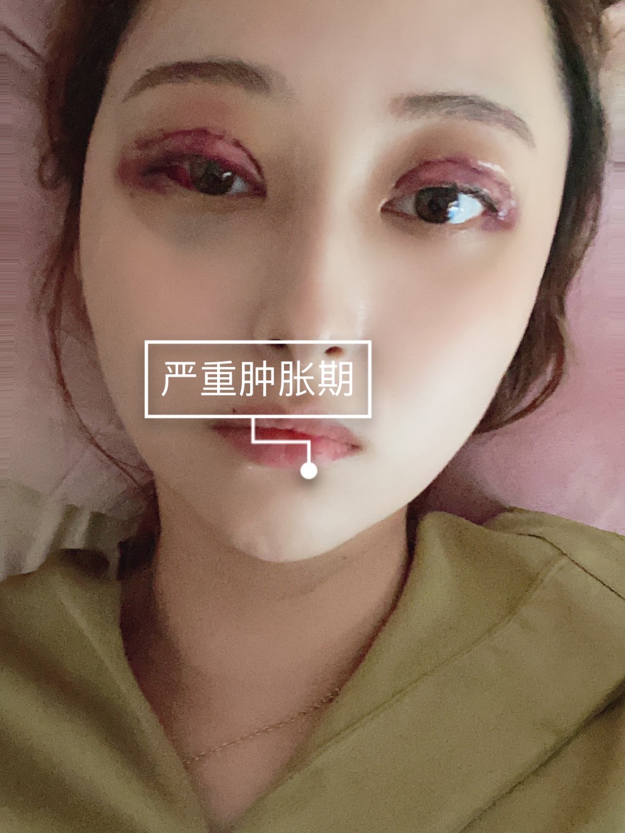 尚美陶院长做的双眼皮综合,全切双眼皮加眼窝脂肪填充_圈子-新氧美容