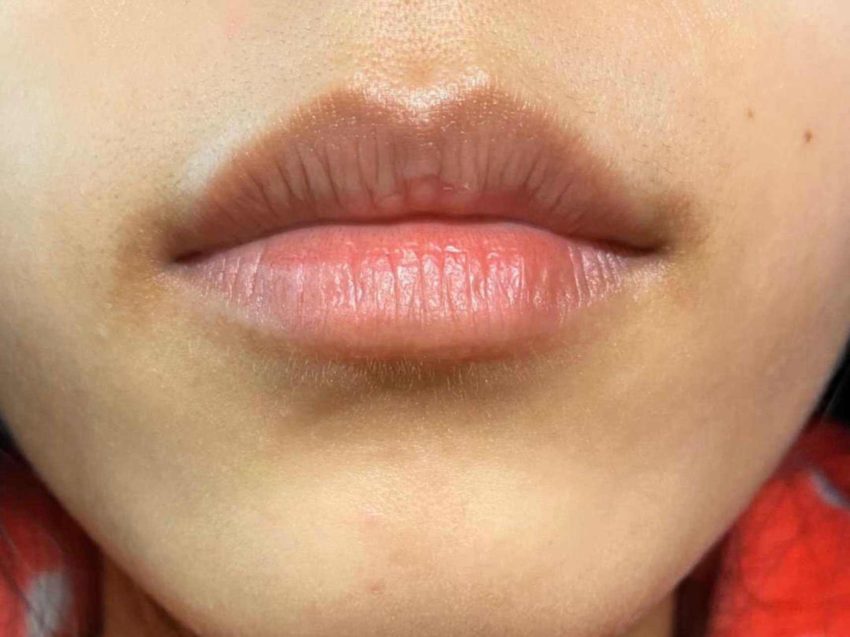 唇部脱毛前后对比图