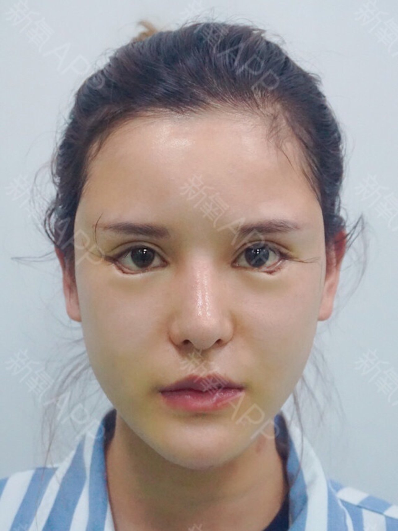 就做了一款比较自然的,刚做完第一天看起来也就是下至拉开了一点,外