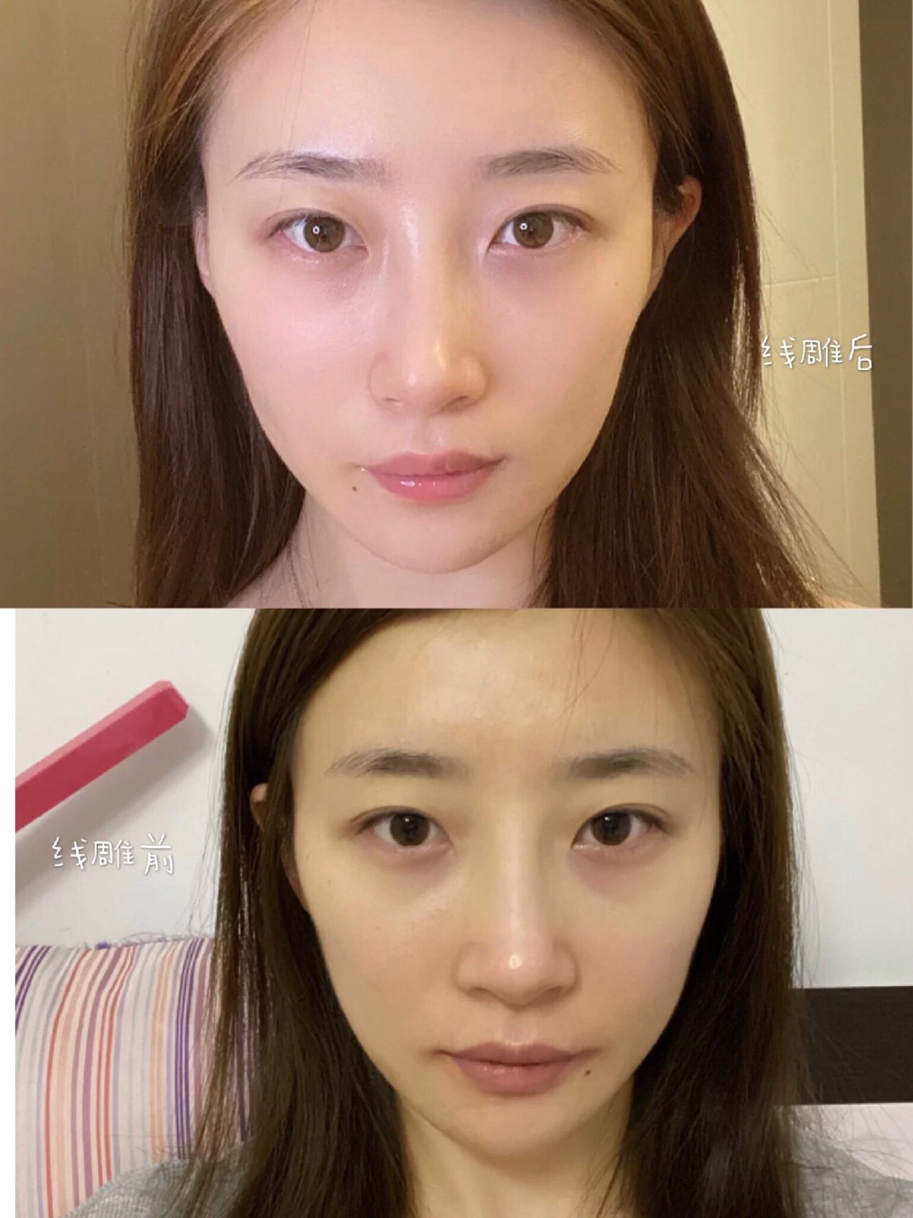 绝不后悔做线雕!前后对比图