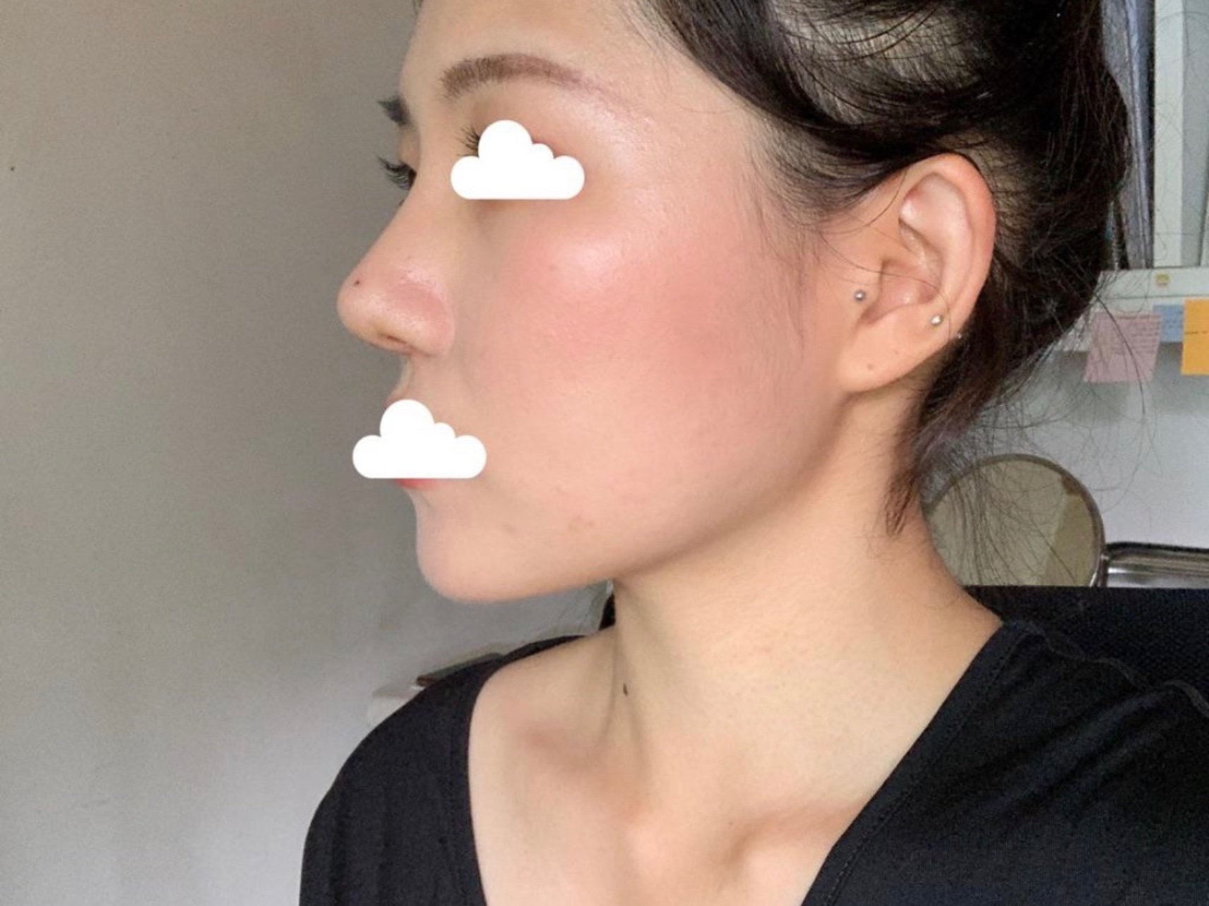 垫了鼻基底鼻子都高了好多,法令纹也改善了,服务体验_圈子-新氧美容