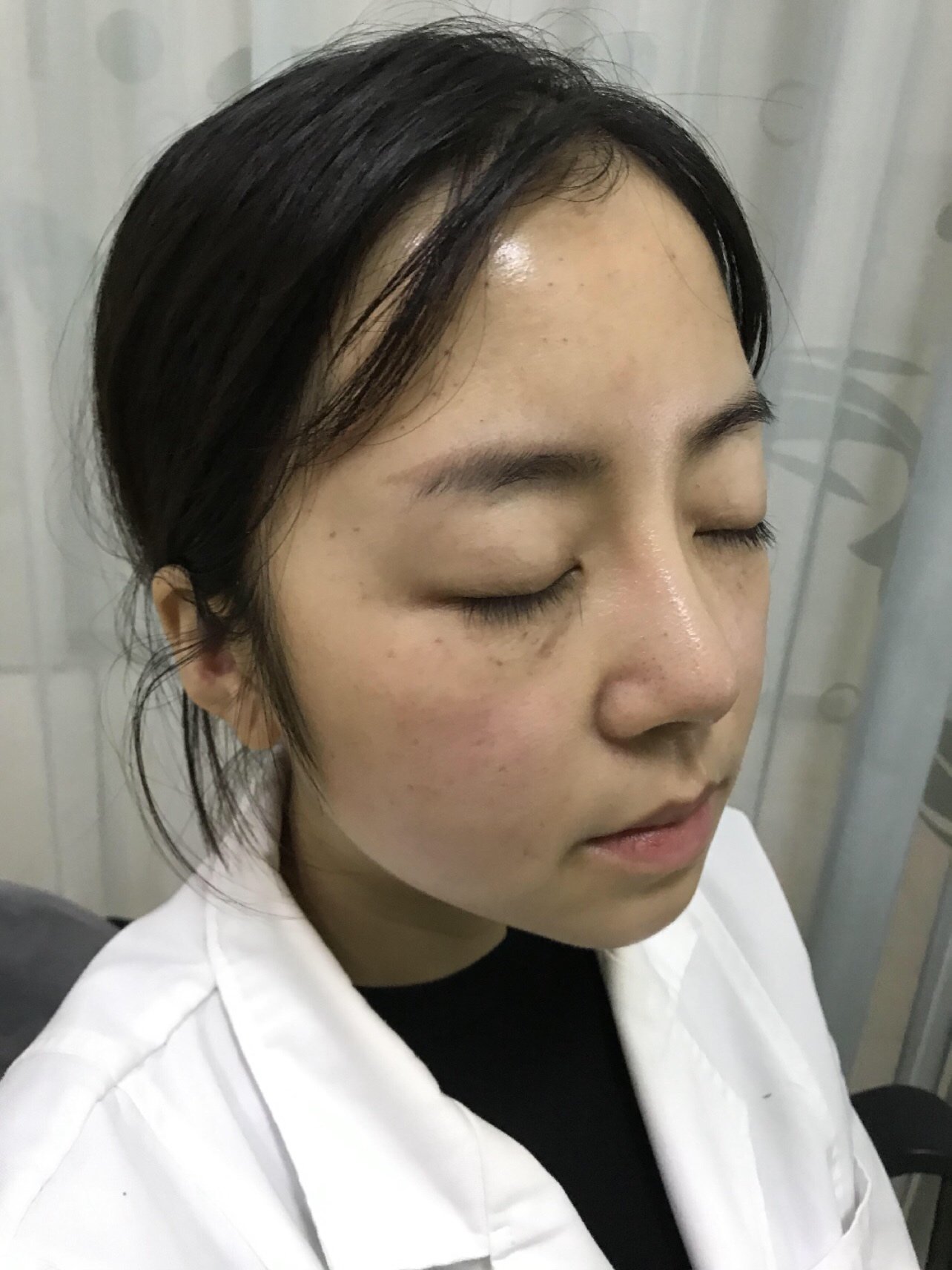 【丝丽动能素水光补水项目术后3天】