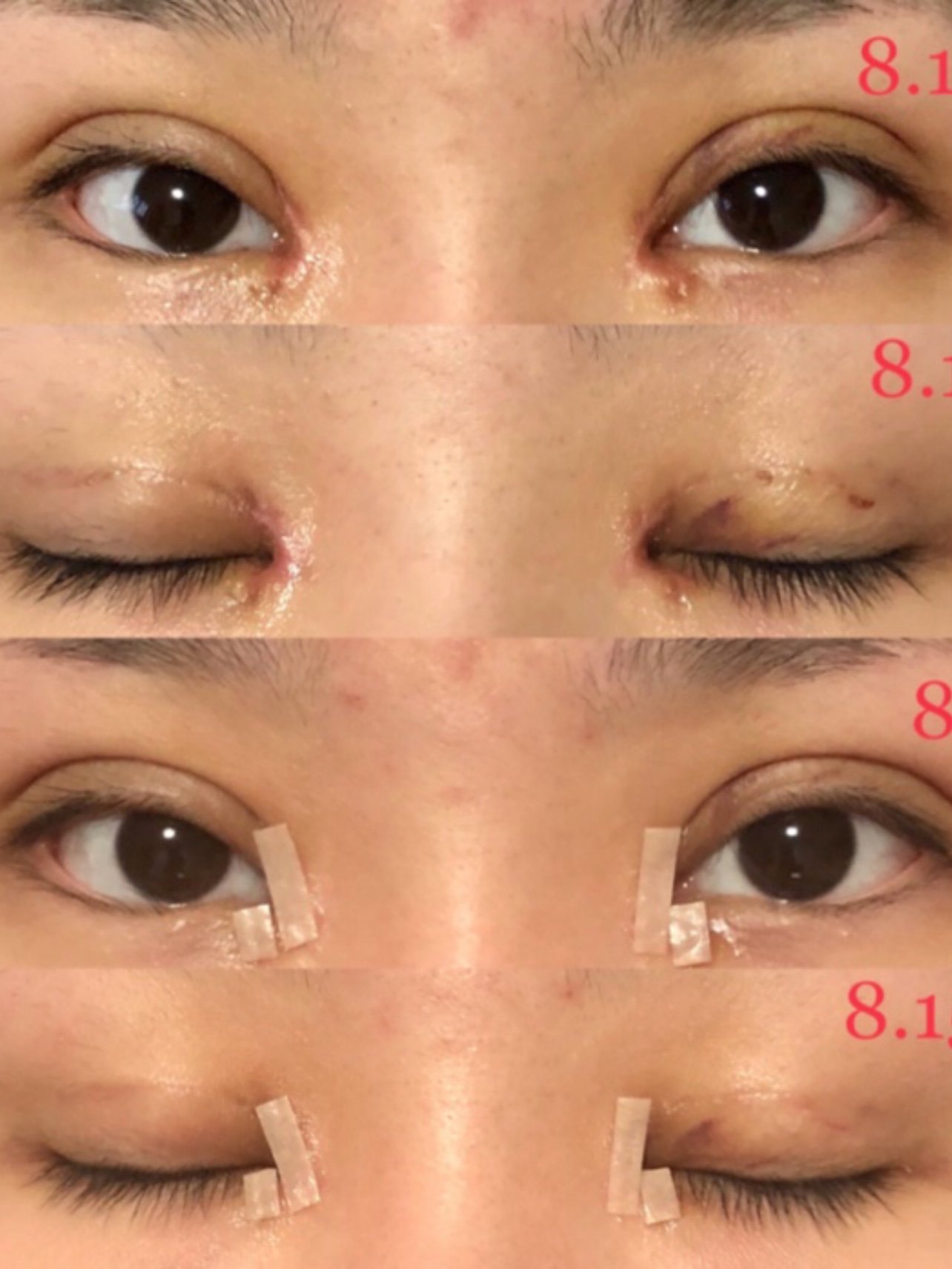 开内眼角祛脂肪埋线双眼皮术后分享