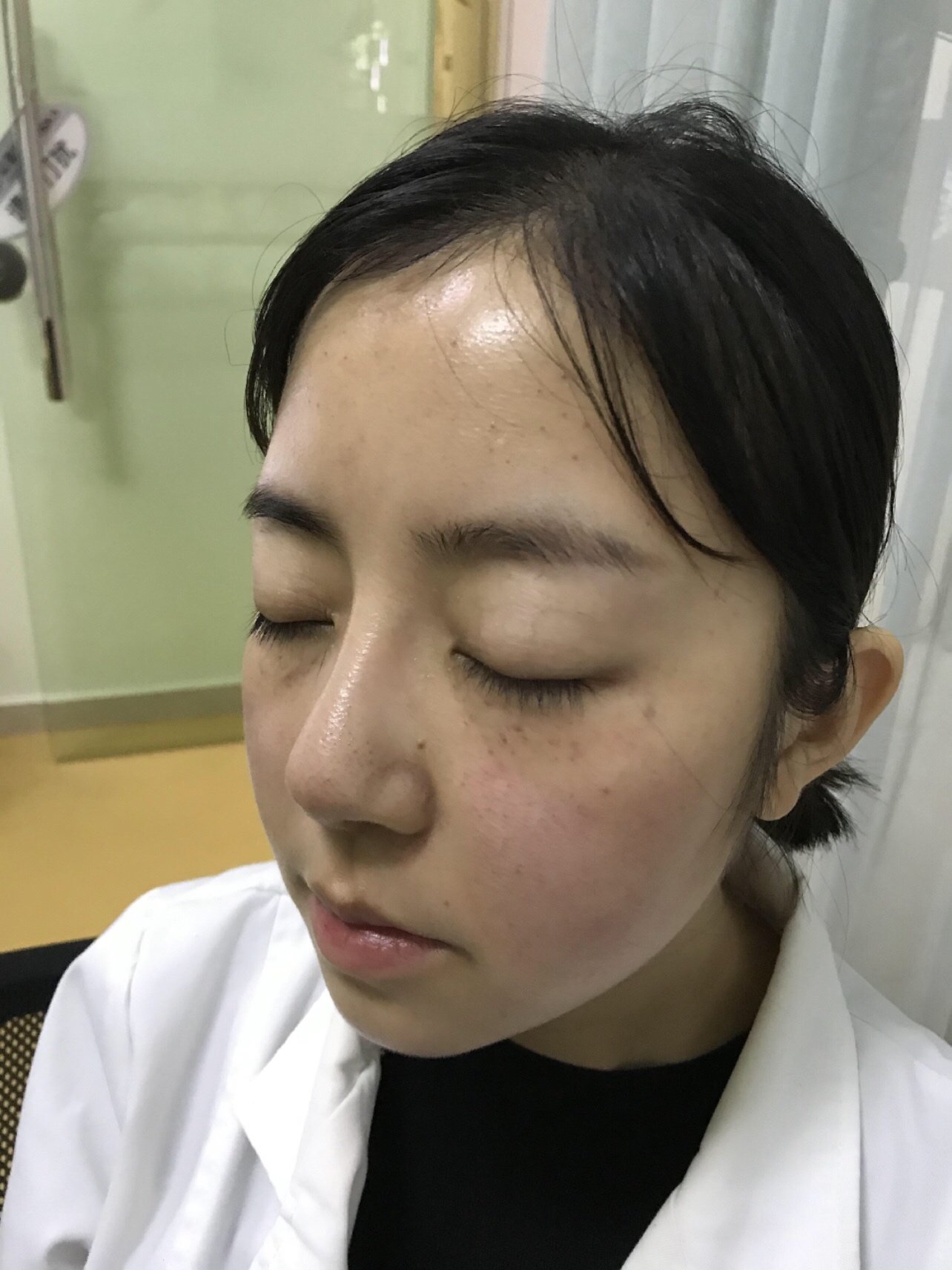 【丝丽动能素水光补水项目术后3天】