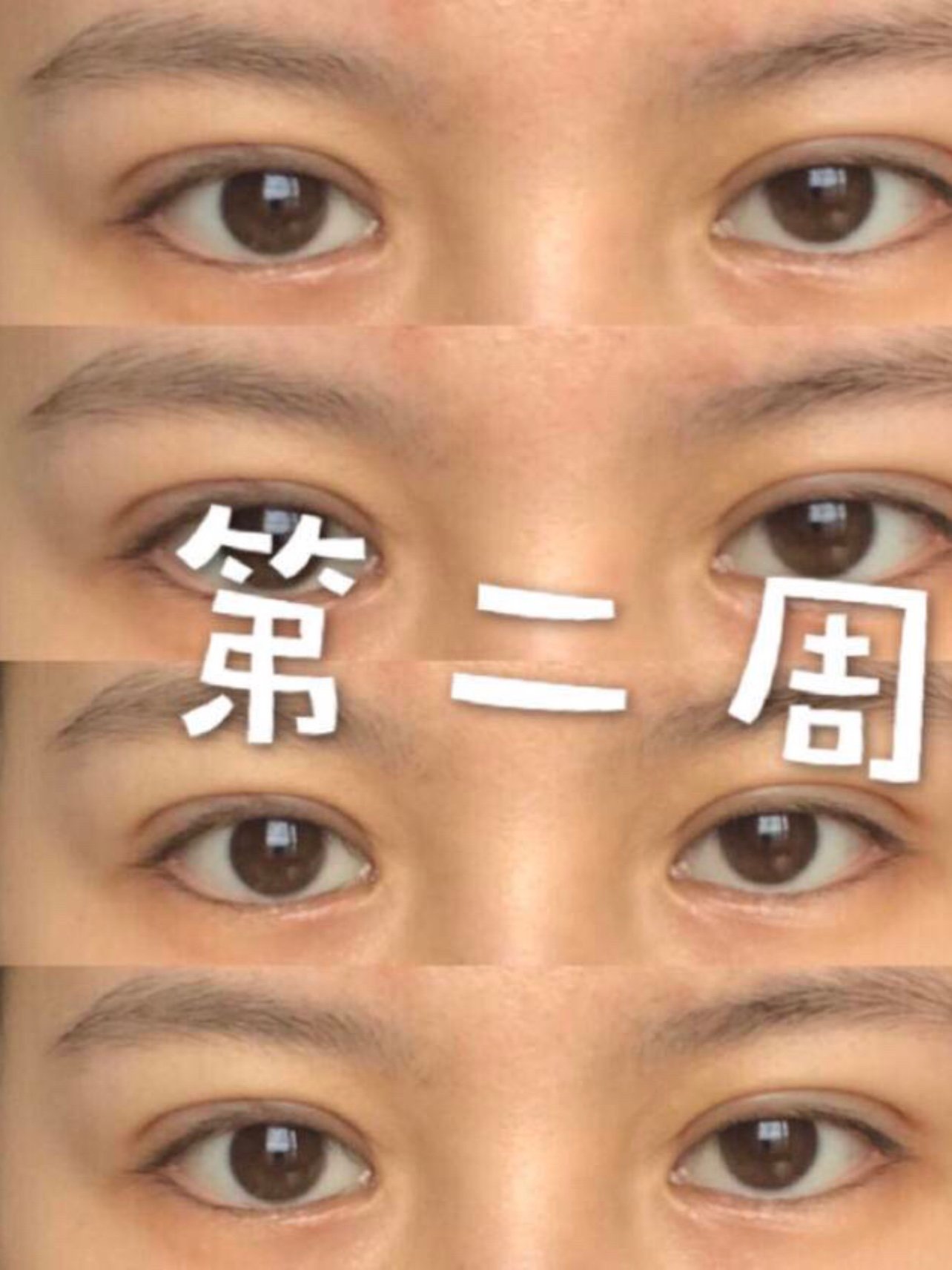韩式三点式双眼皮效果图片