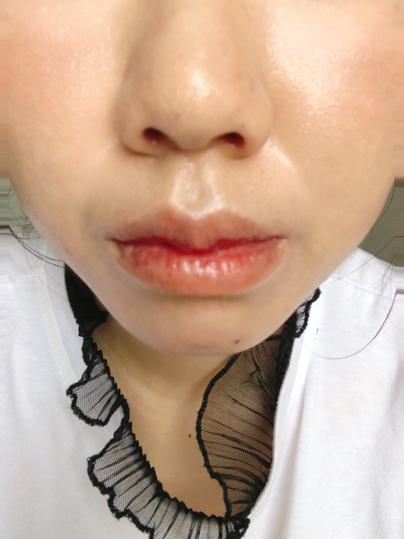 唇部改薄拆线后第十五天