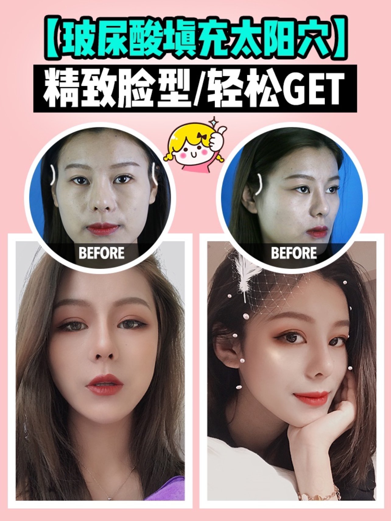 【玻尿酸填充太阳穴】精致脸型,轻松get