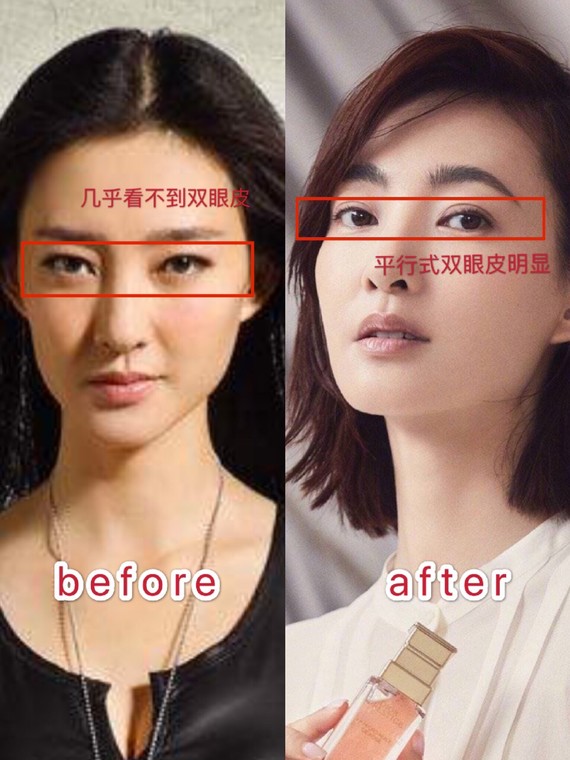 王丽坤承认割双眼皮图片