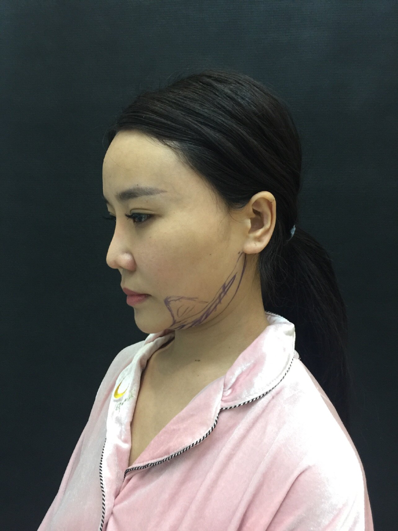 做的是下颌缘吸脂,医生手法很好,给我做的很完美.