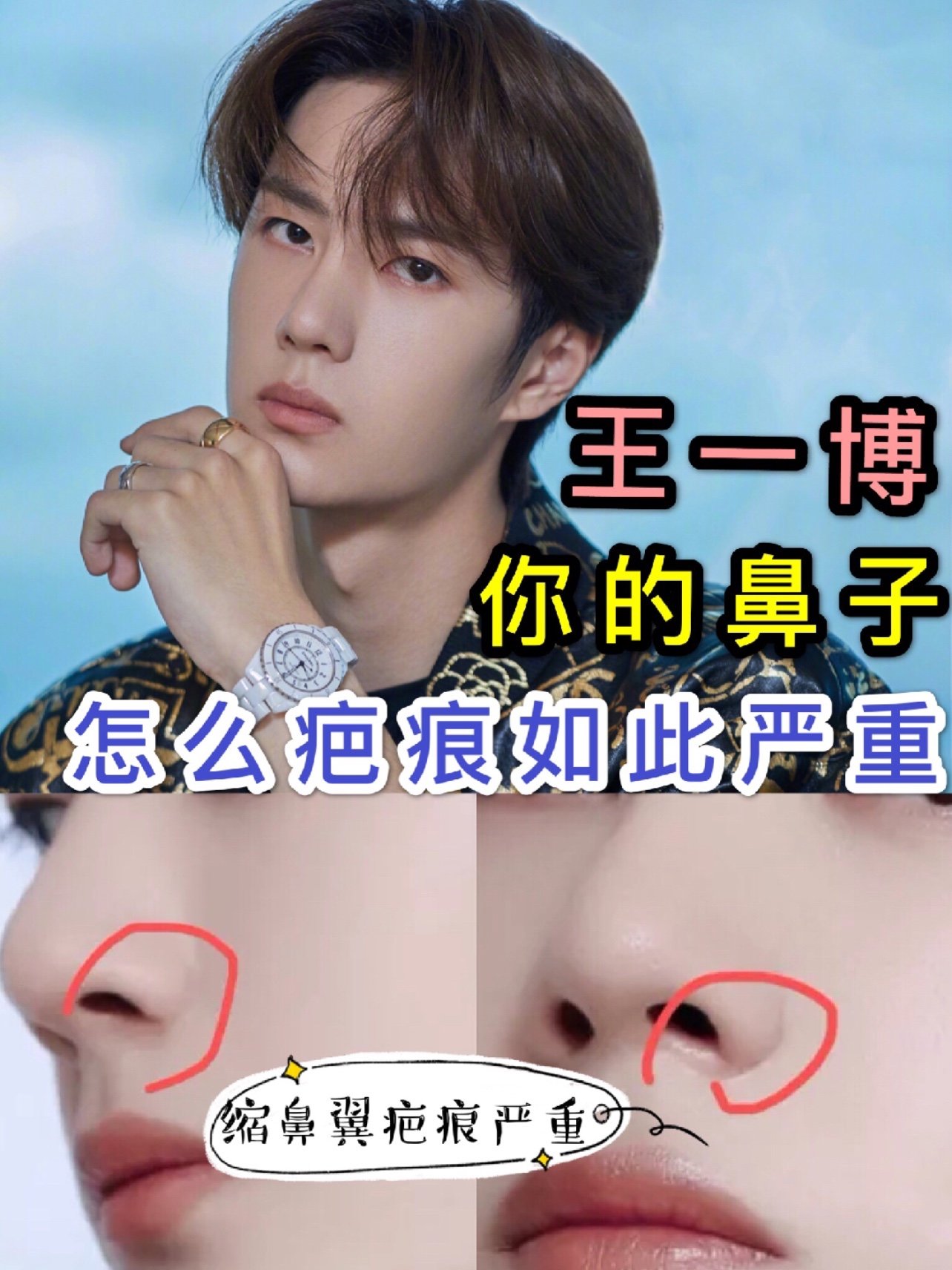 王一博 你的鼻子怎么疤痕如此严重·95王一博缩鼻翼—_圈子-新氧
