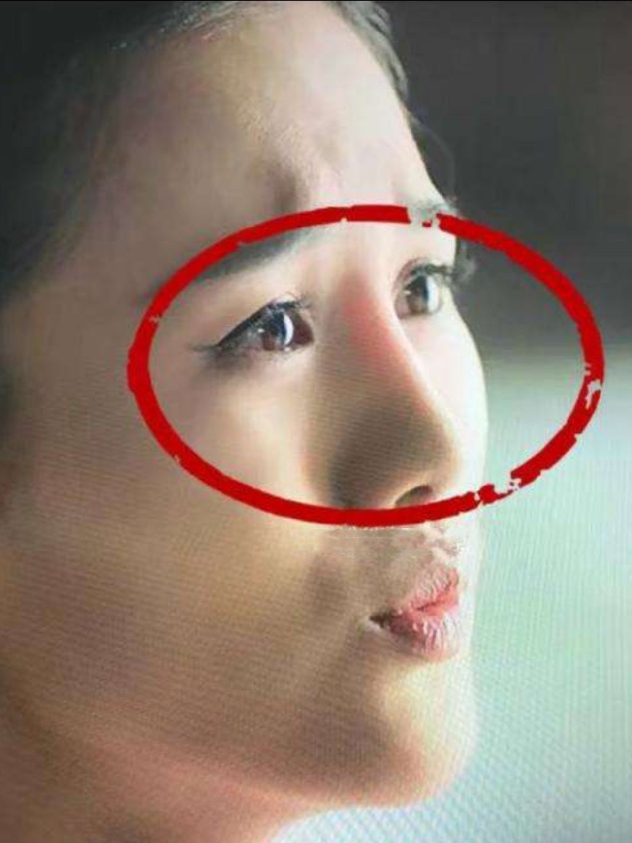 隆鼻后鼻子透光怎么办?